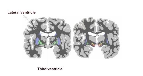 A coronal section through the brain